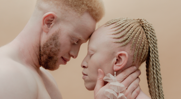 coppia di ragazzi albini africani