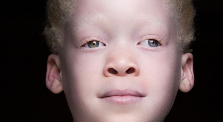 albinismo aspettativa di vita